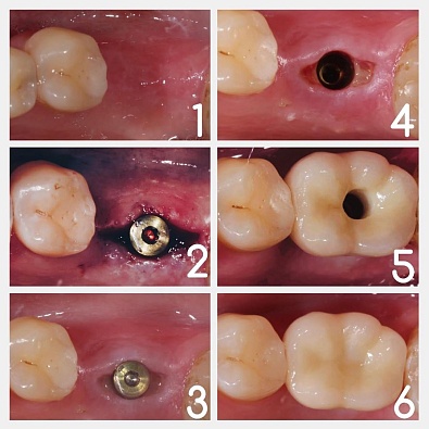 Этапы восстановления отсутствующих зубов.