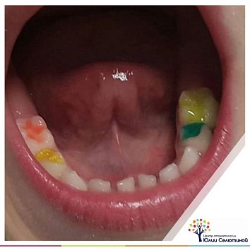 Цветные пломбы в детской стоматологии