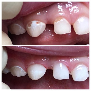 Клинический случай: кариес центральных зубов.