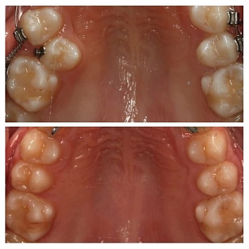 Почему важно сохранять молочные зубы? Ортодонтический случай.
