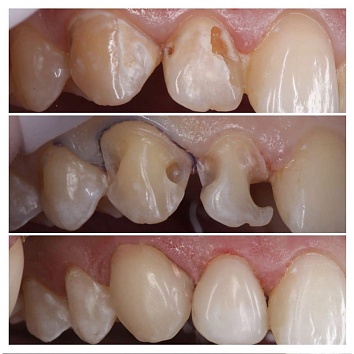 Реставрация зубов центральной группы 