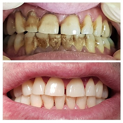 Природная санация зубов в практике стоматолога 