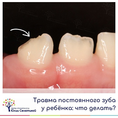 Травма постоянного зуба у ребенка: что делать? 