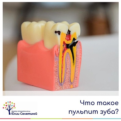 Что такое пульпит зуба? 