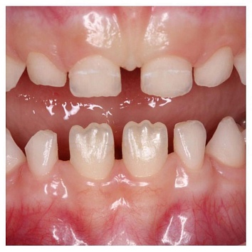 Чем молочные зубы отличаются от постоянных?