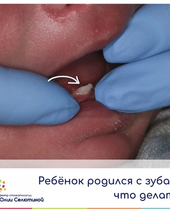 Ребёнок родился с зубами: что делать?