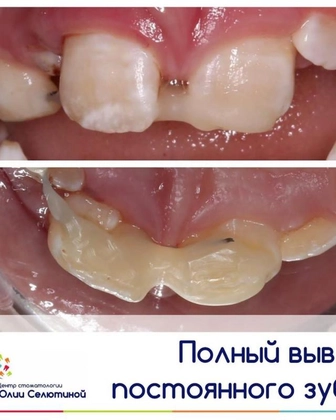 Что такое полный вывих зуба?