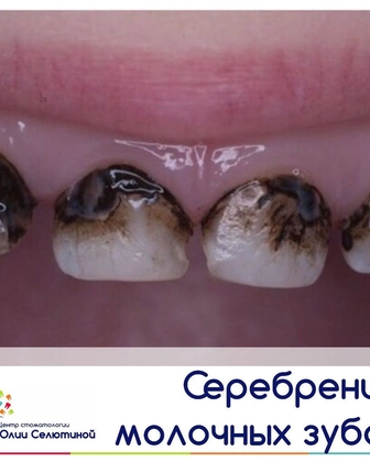 Почему я не рекомендую серебрение зубов?