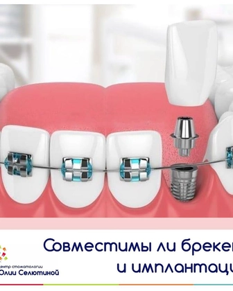 Совместимы ли брекет-лечение и имплантация?