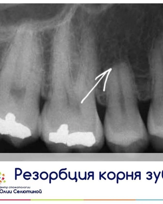 Резорбция корней зубов.