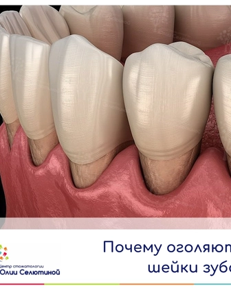 Почему оголяются шейки зубов?