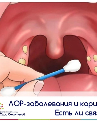 ЛОР-заболевания и кариес: есть ли связь?