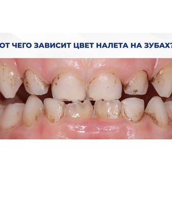 появление налета на зубах