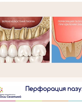 Осложнения: перфорация верхнечелюстной пазухи.