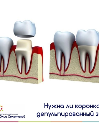 Нужна ли коронка на депульпированный зуб?