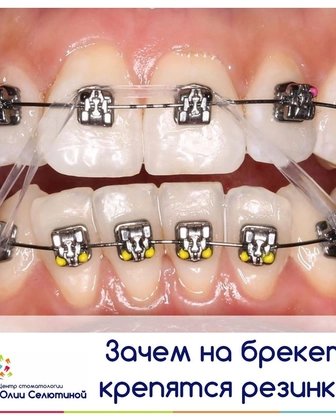 Для чего на брекетах нужны "резинки"?
