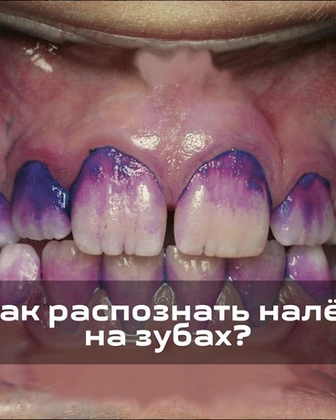 Как распознать налет за зубах