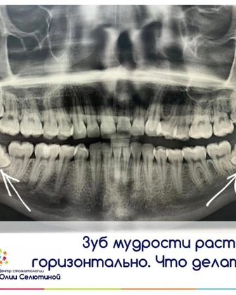 Нужно ли удалять зубы "мудрости"?