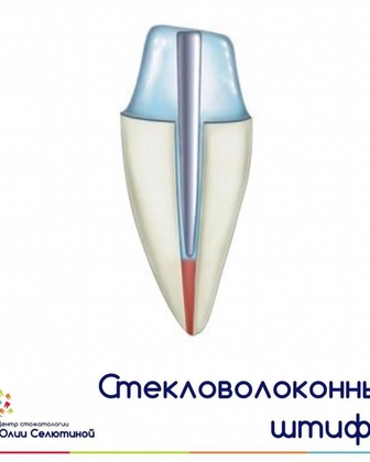 Стекловолоконный штифт: показания и преимущества.