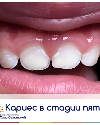Как начинается кариес у ребёнка?