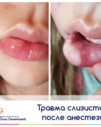 Травма слизистой оболочки после местной анестезии.