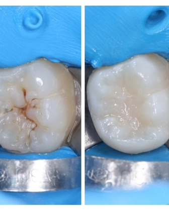 Герметизация фиссур - профилактика кариеса