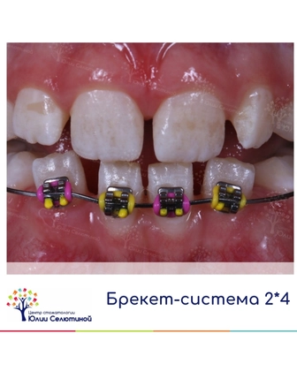 Частичная брекет-система у детей 