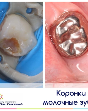 Лечение молочных зубов с применением коронок. 