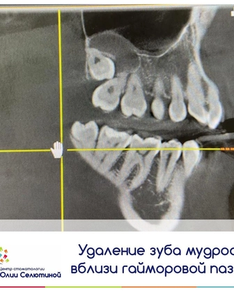 Удаление зубов мудрости вблизи гайморовой пазухи: в чем сложность?