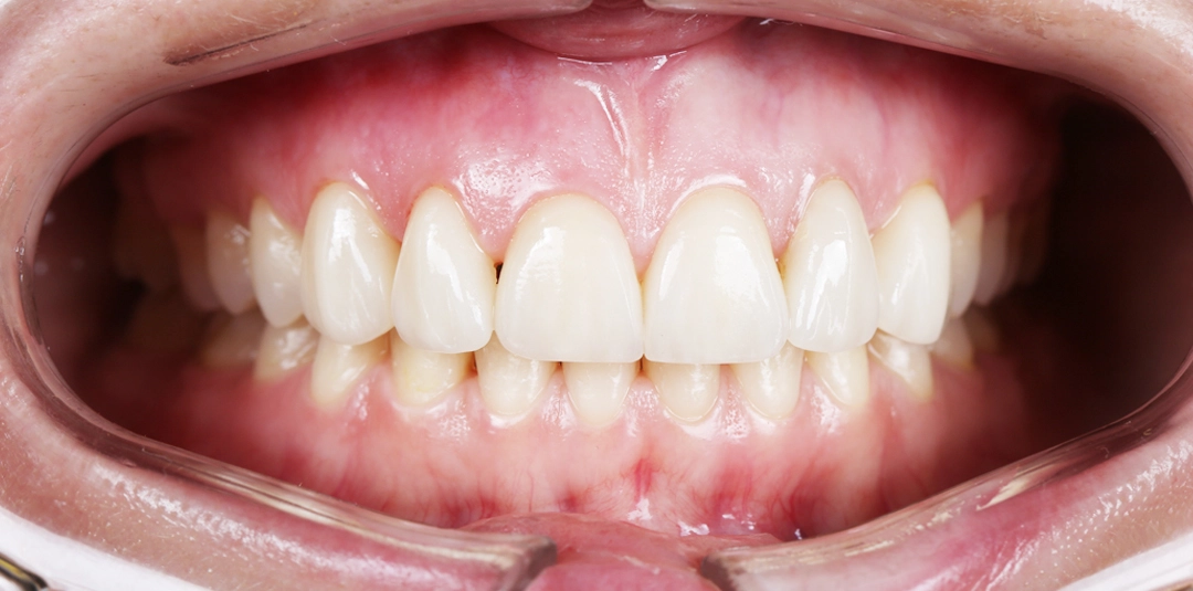 Изображение зубов после выполненой работы