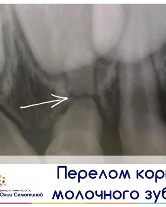 Как выявить перелом корня молоного зуба?