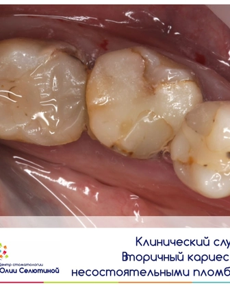 Вторичный кариес и несостоятельгые пломбы 