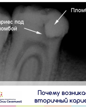 Почему возникает вторичный кариес?