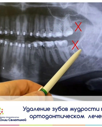 Удаление зуба мудрости по ортодонтическим показаниям.