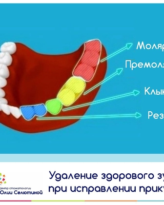 Удаление зуба по ортодонтическим показаниям.