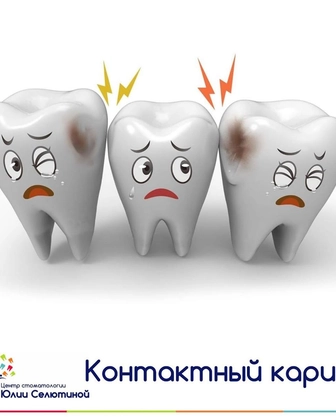 Контактный кариес: чем он опасен?