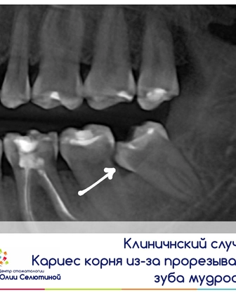 Клинический случай: кариес корня из-за прорезывания зуба мудрости.