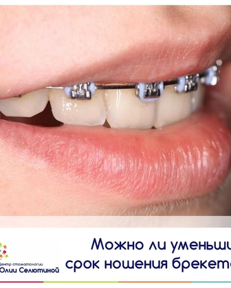 Можно ли уменьшить срок ношения брекетов?