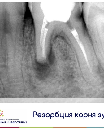 Что делать, если началась резорбция корня зуба?