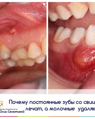 Почему постоянные зубы со свищом лечат, а молочные удаляют?