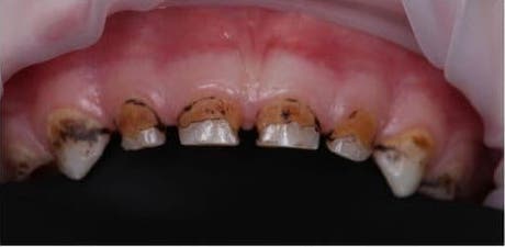 Лечение в наркозе (пациенту 4,5 года, вылечено 12 зубов)