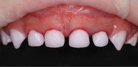 Лечение в наркозе (пациенту 2,5 года, вылечено 16 зубов)