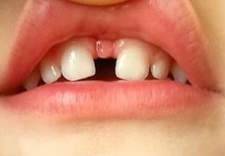 Короткая уздечка верхней губы: чем чревато?