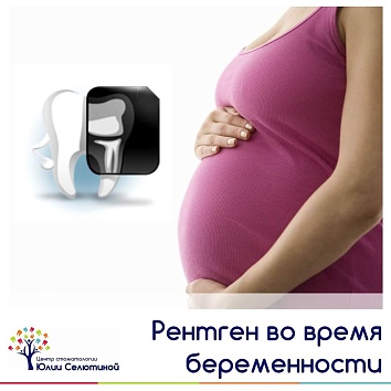 Рентген и беременность 