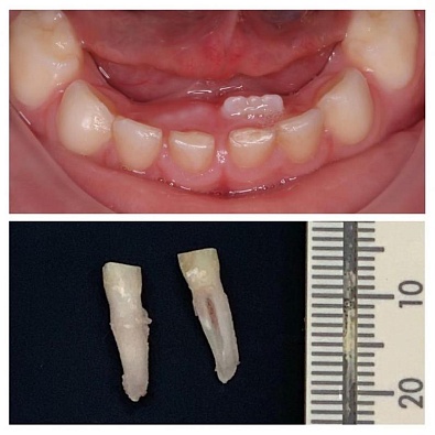 Молочные зубы у взрослых! – Аномалия или норма?
