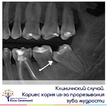 Клинический случай: кариес корня из-за прорезывания зуба мудрости. 