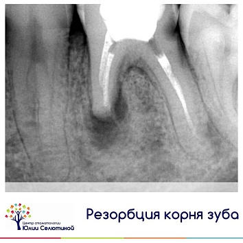 Что делать, если началась резорбция корня зуба? 