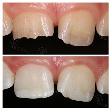 Клинический случай: скол центрального зуба 