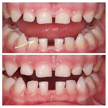 Всегда ли лечим скол зуба с постановкой пломб?