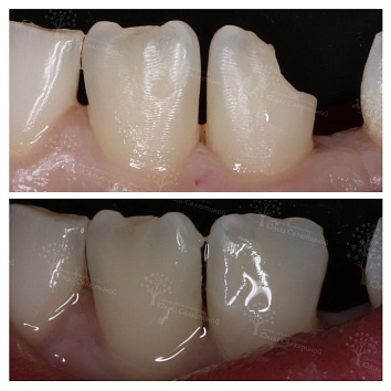 Скол центрального зуба: как восстанавливали 